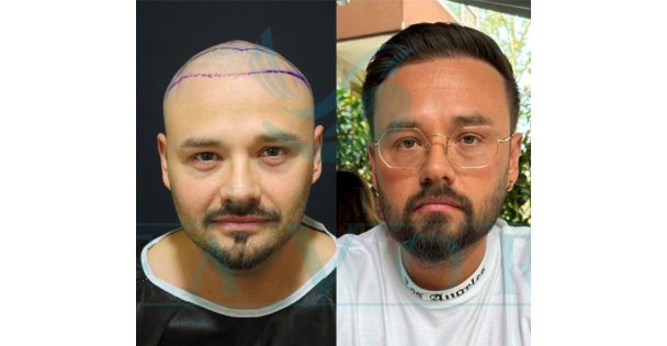 2025'in En İyi Saç Ekim Merkezleri ve Güncel Fiyatları