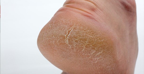 Topuk Çatlağı Deyip Geçmeyin!